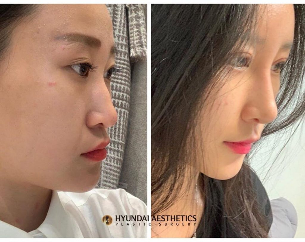 Chỉnh mũi gồ và sống mũi thấp/ Hyundai Aesthetics