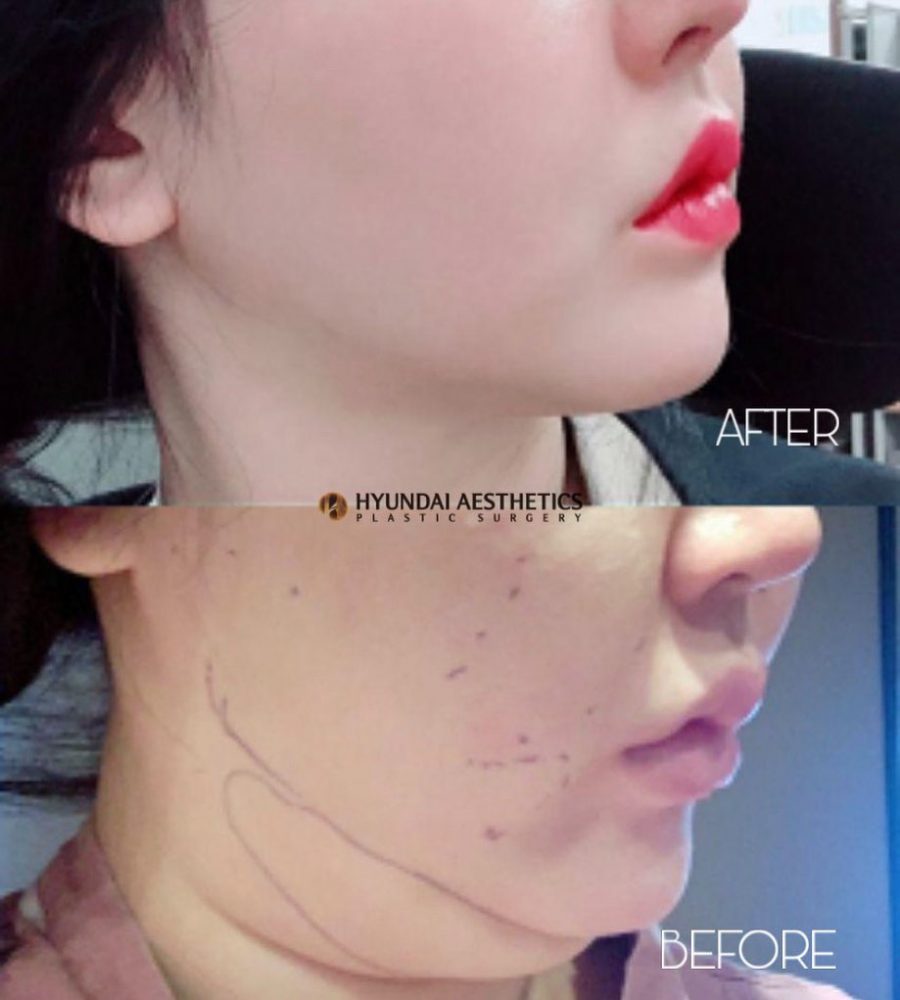 Hút mỡ nọng cằm/ Huyndai Aesthetics 